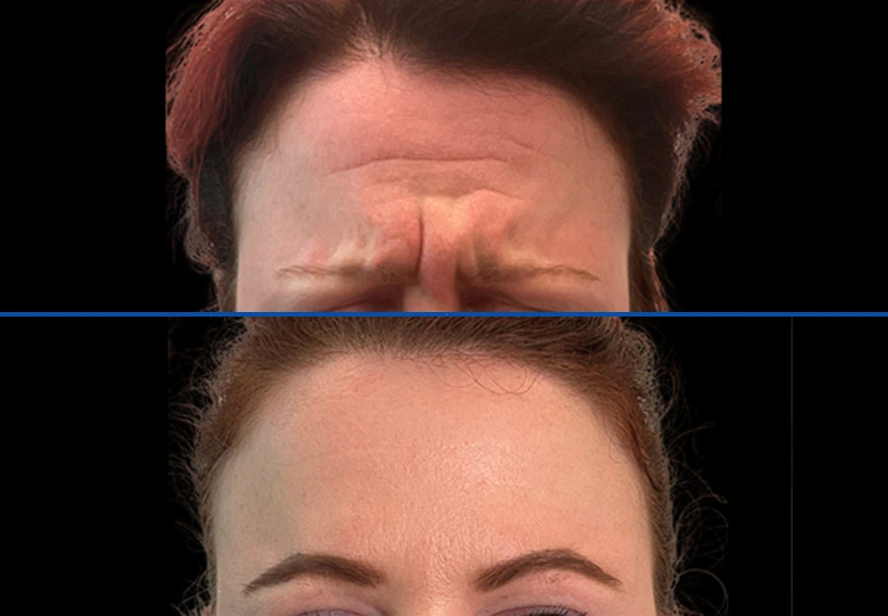 botox6|Exert Clinic