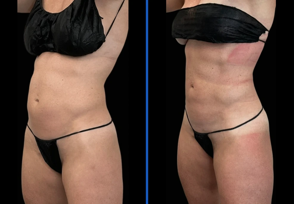 ab-1|Exert Clinic