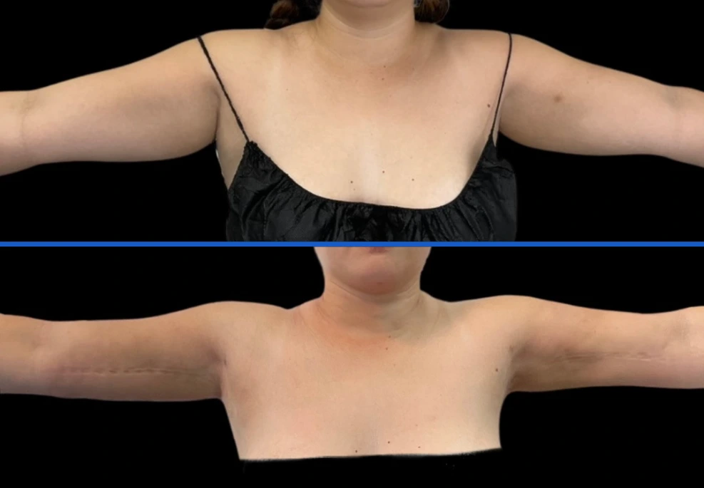 arm5|ExertClinic