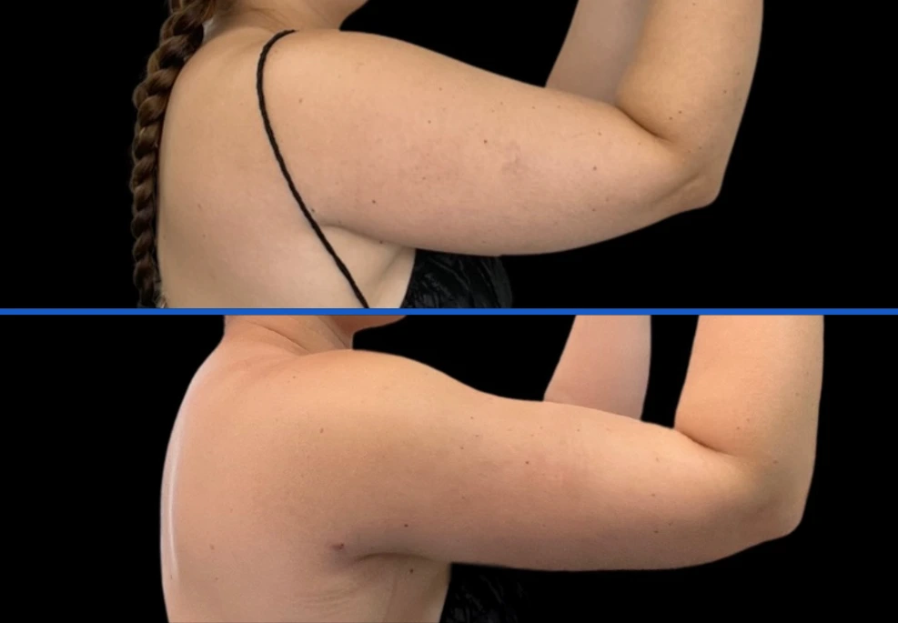 arm6|Exert Clinic