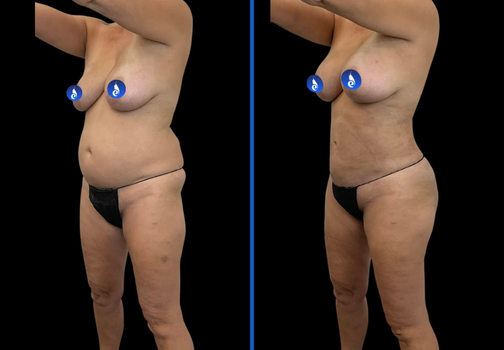 bblbreast|Exert Clinic