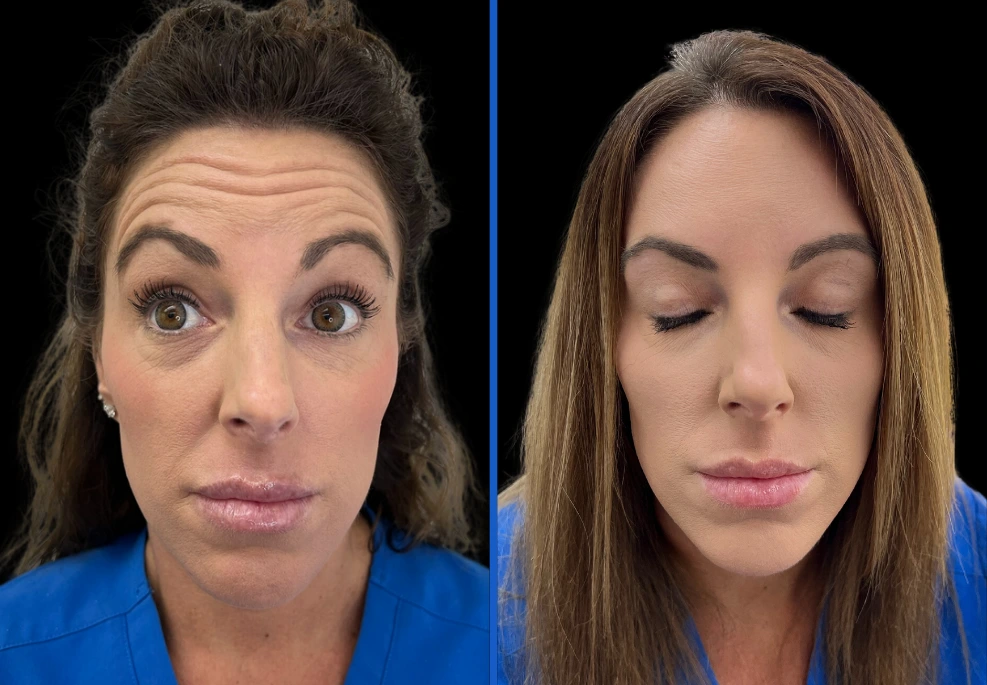 botox3|Exert Clinic