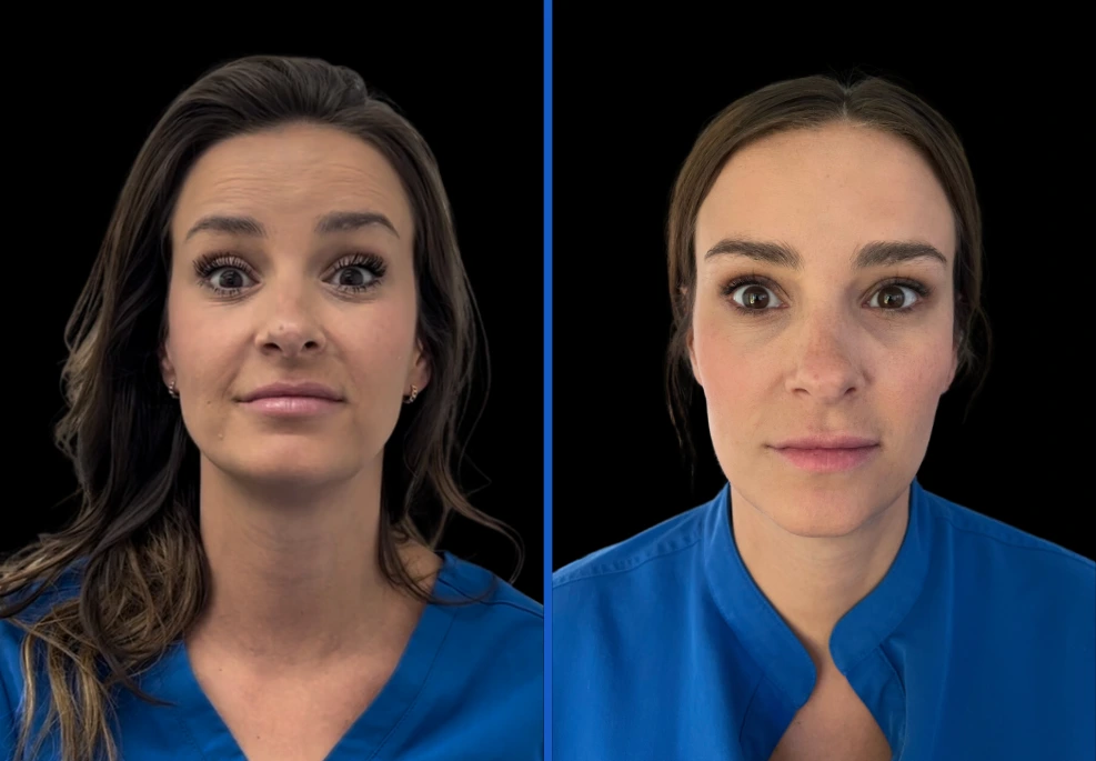 botox5|Exert Clinic