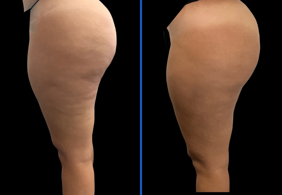 1aveli|Exertclinic