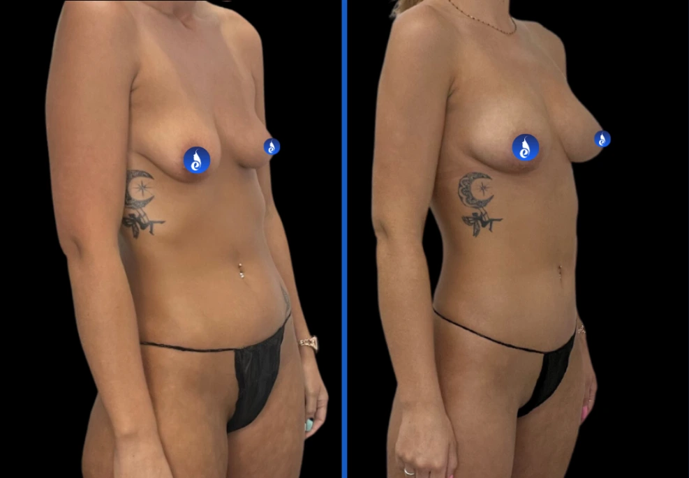 3breastxpress|Exert Clinic