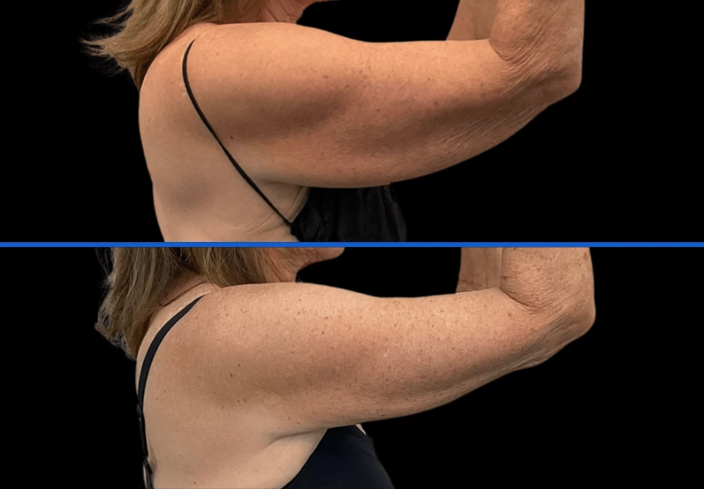 arm10|Exert Clinic