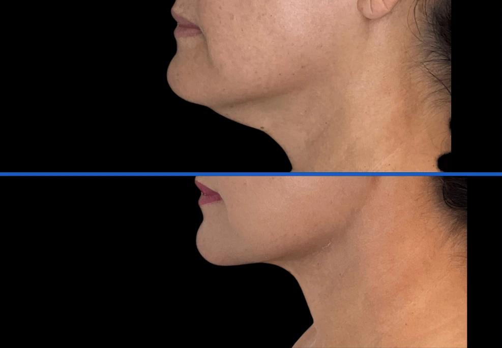 chin3|Exert Clinic