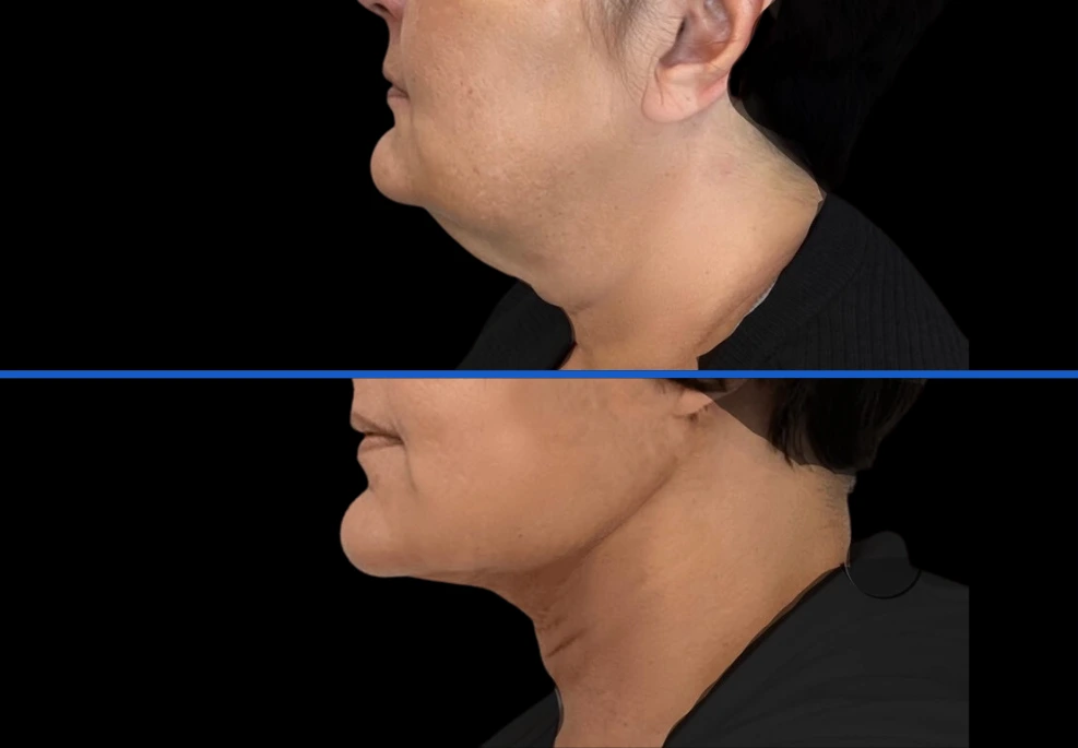chin4|Exert Clinic