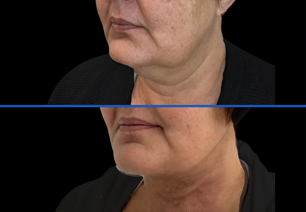 chin5|Exert Clinic
