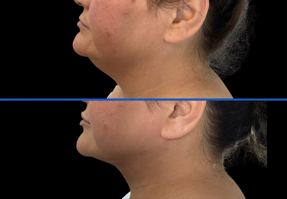 chin filler
