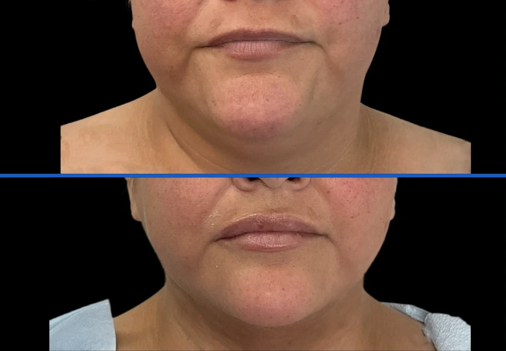 chin8|Exert Clinic