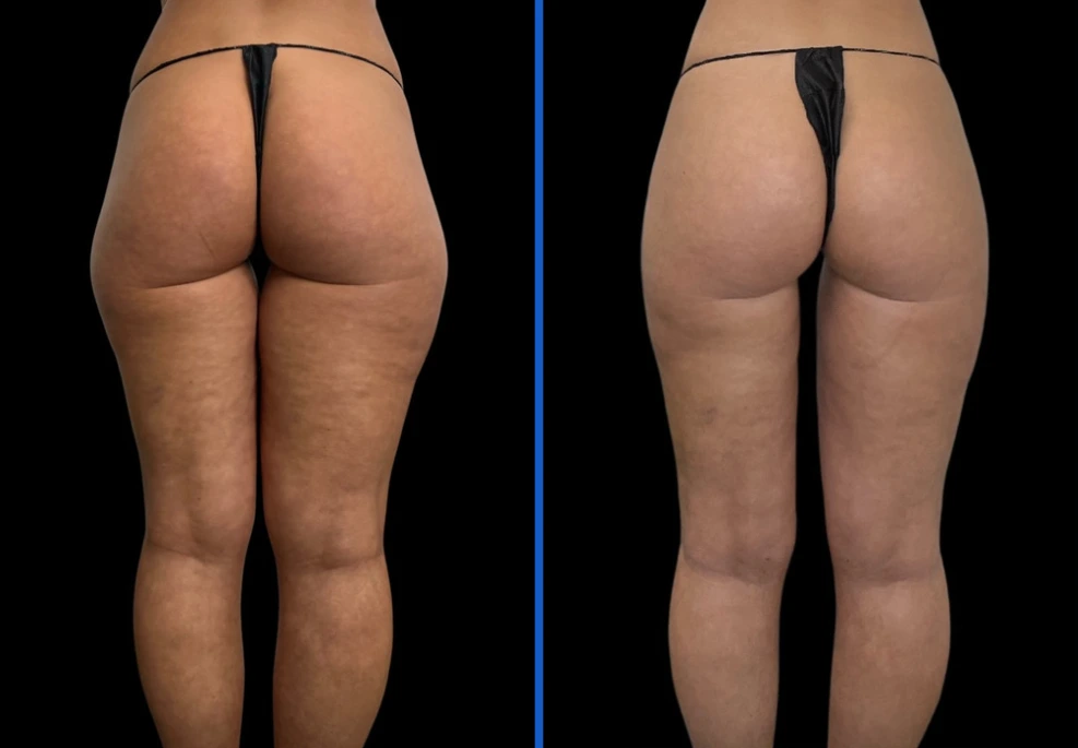 thighxpress |Exert Clinic