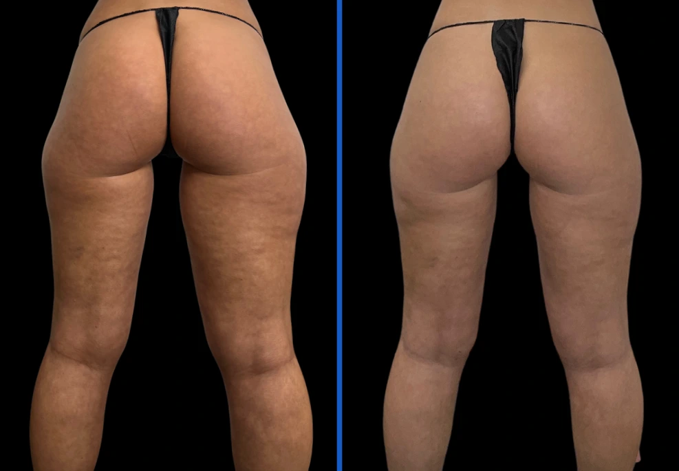 thighxpress2|Exert Clinic