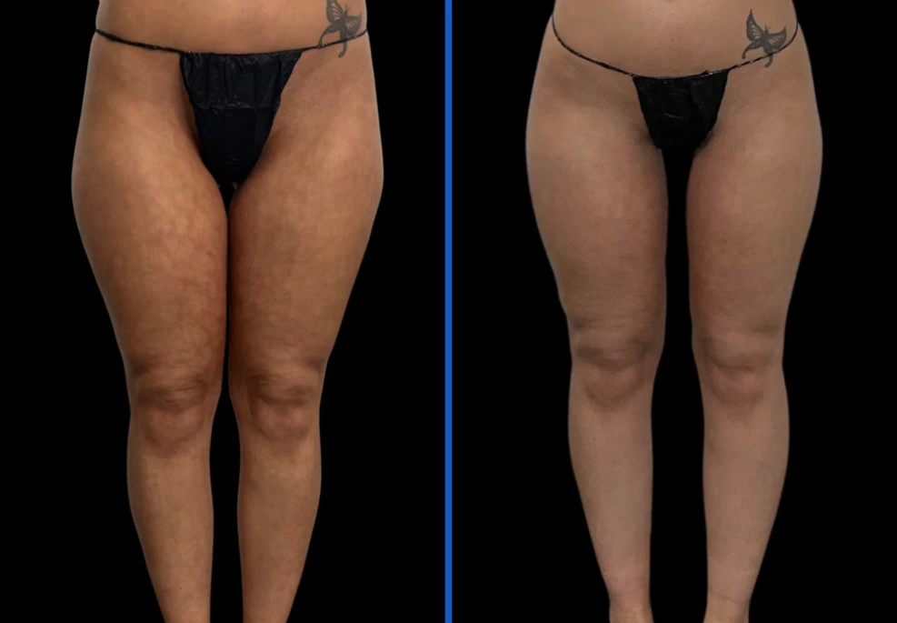 thighxpress3|Exert Clinic