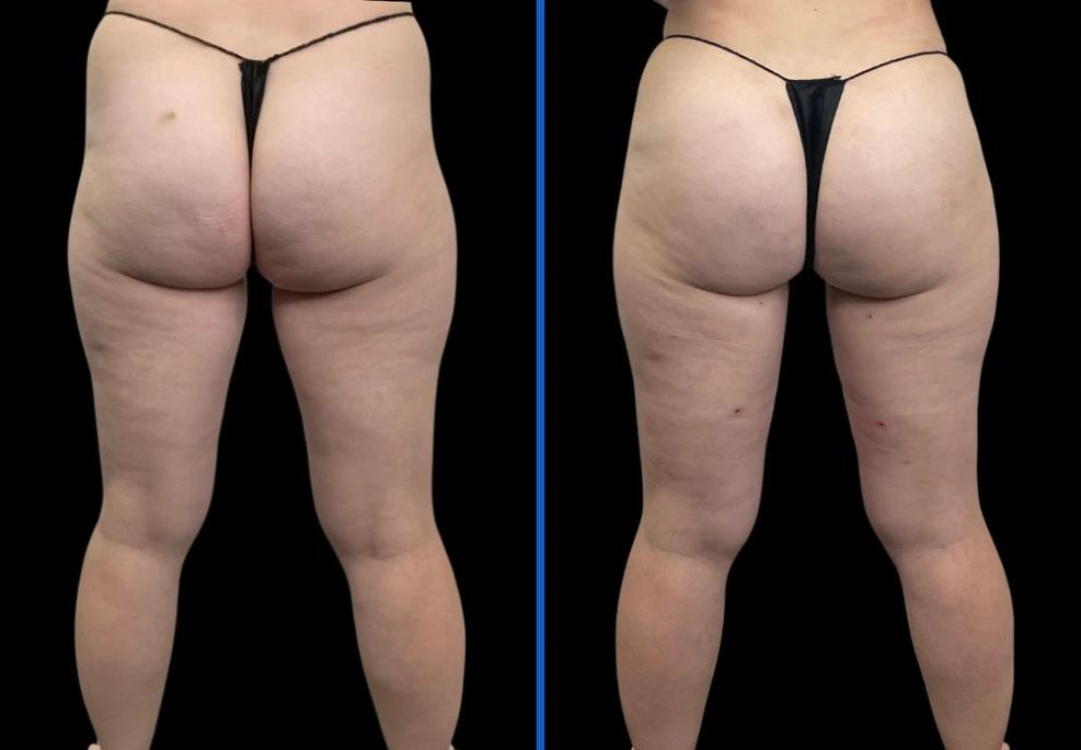 thighxpress6-1|Exert Clinic