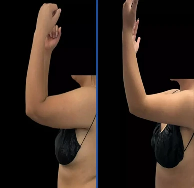Before & after arms Banner