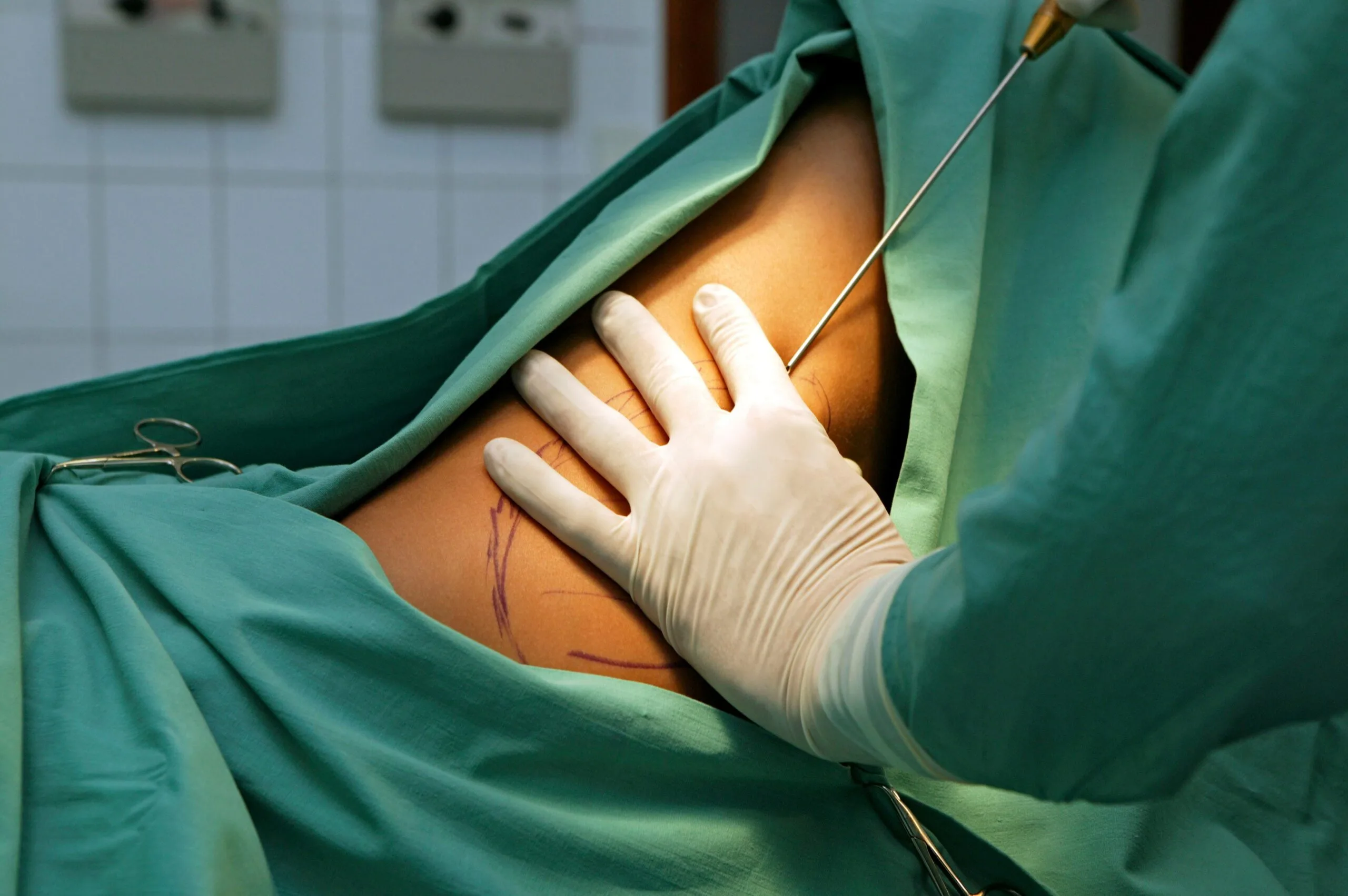 How Is Liposuction Done? Banner