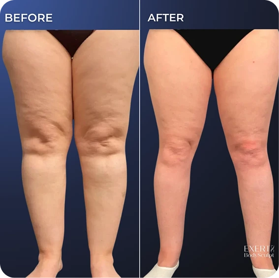 Before and After Gallery: Calf Liposuction
