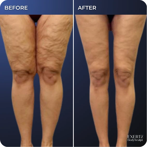 Before and After Gallery: Calf Liposuction
