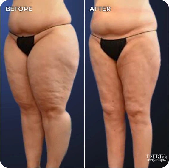 Before and After Gallery: Calf Liposuction